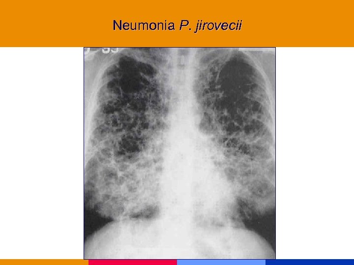 Neumonia P. jirovecii 