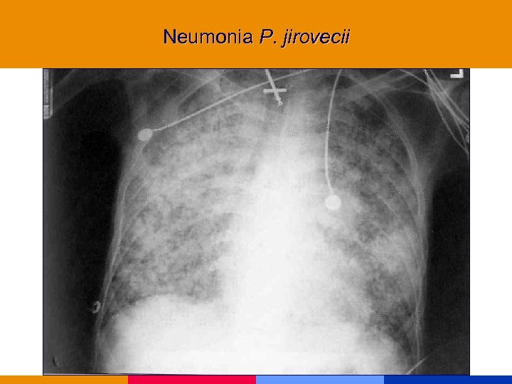 Neumonia P. jirovecii 