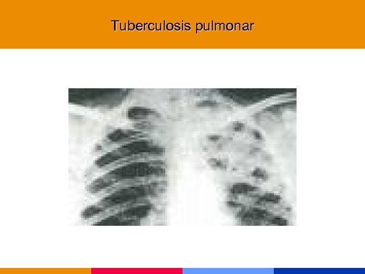 Tuberculosis pulmonar 