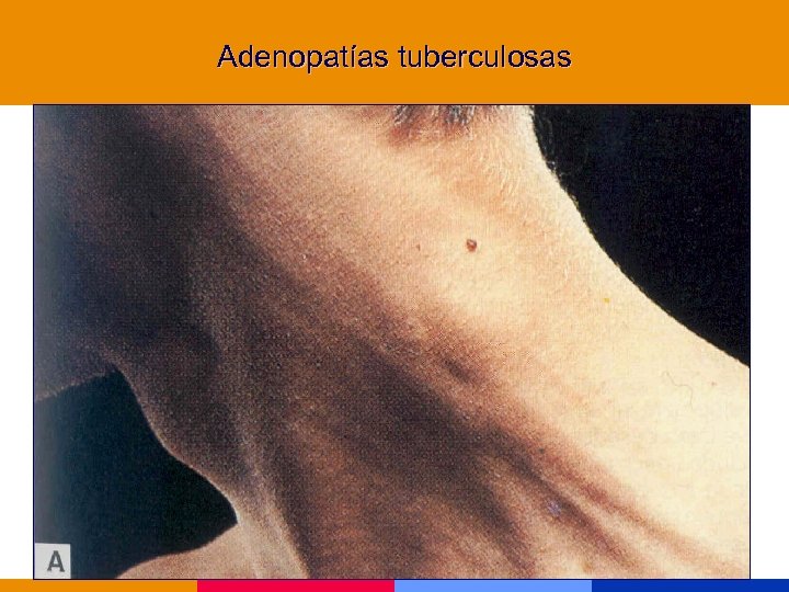 Adenopatías tuberculosas 