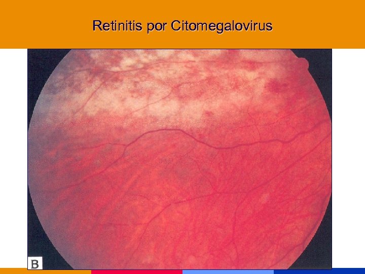 Retinitis por Citomegalovirus 