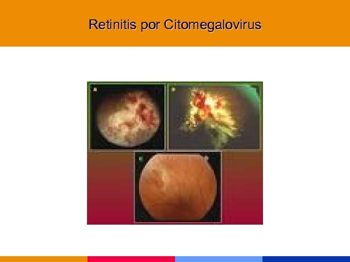 Retinitis por Citomegalovirus 