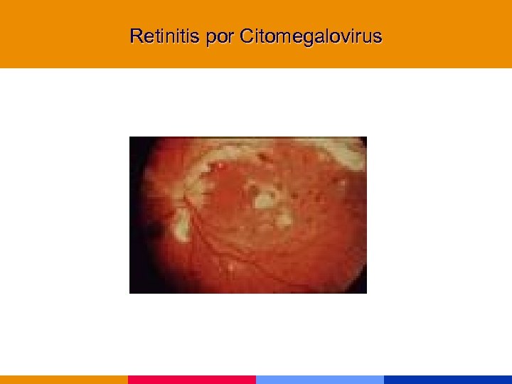 Retinitis por Citomegalovirus 