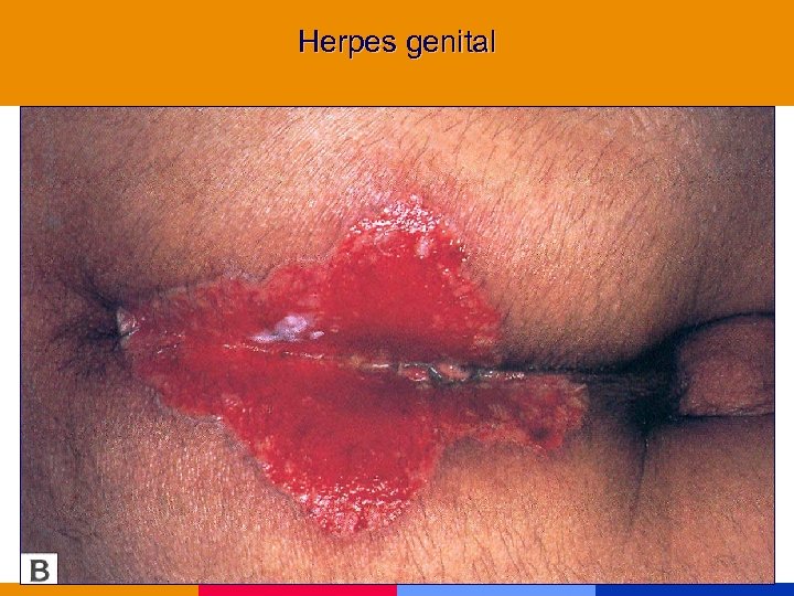Herpes genital 