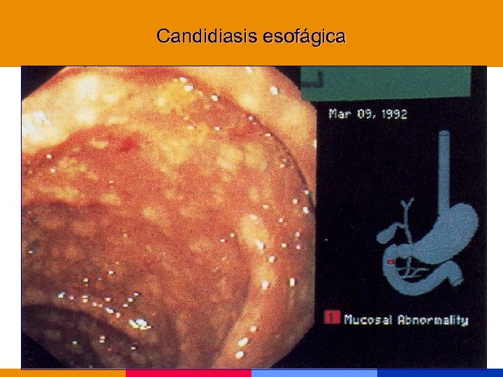 Candidiasis esofágica 
