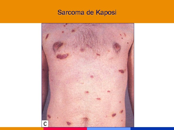 Sarcoma de Kaposi 