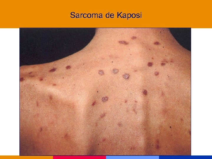 Sarcoma de Kaposi 