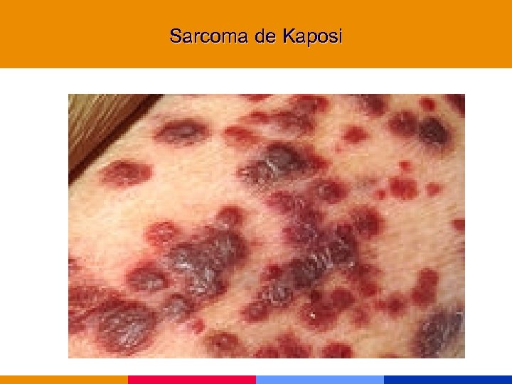 Sarcoma de Kaposi 