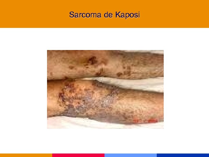Sarcoma de Kaposi 