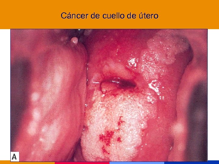 Cáncer de cuello de útero 