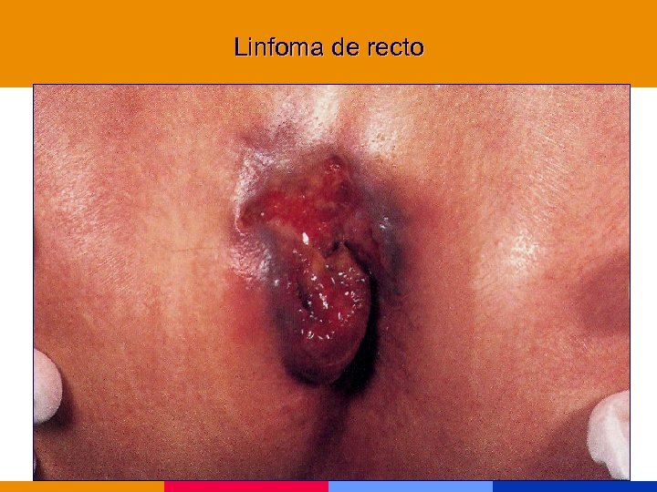 Linfoma de recto 