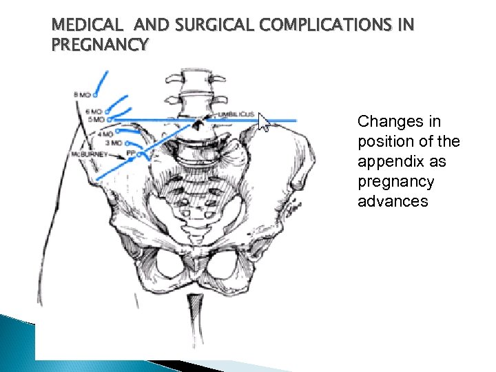 MEDICAL AND SURGICAL COMPLICATIONS IN PREGNANCY Changes in position of the appendix as pregnancy