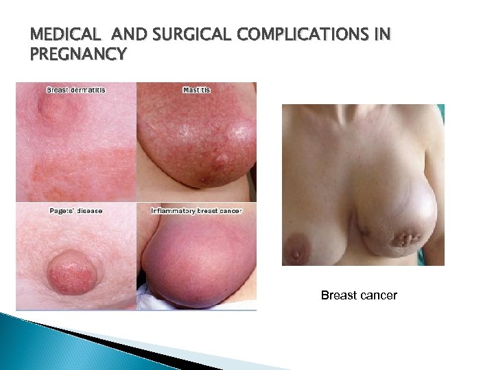 MEDICAL AND SURGICAL COMPLICATIONS IN PREGNANCY Breast cancer 