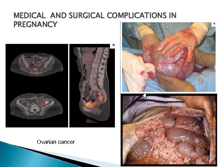 MEDICAL AND SURGICAL COMPLICATIONS IN PREGNANCY Ovarian cancer 