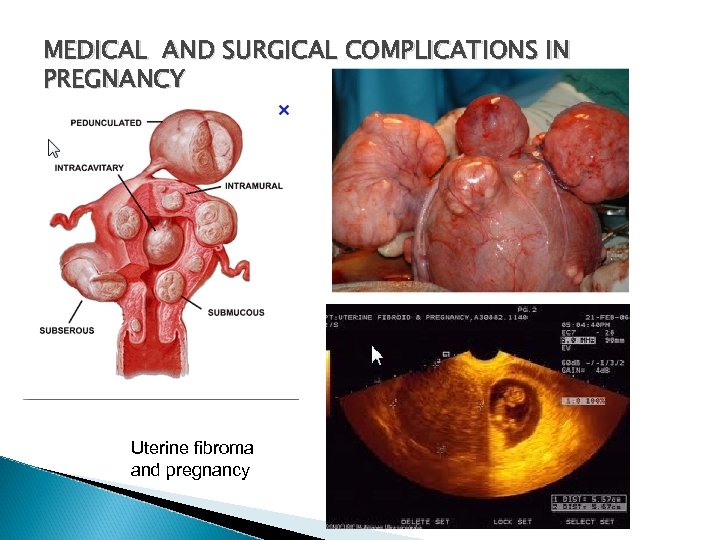 MEDICAL AND SURGICAL COMPLICATIONS IN PREGNANCY Uterine fibroma and pregnancy 