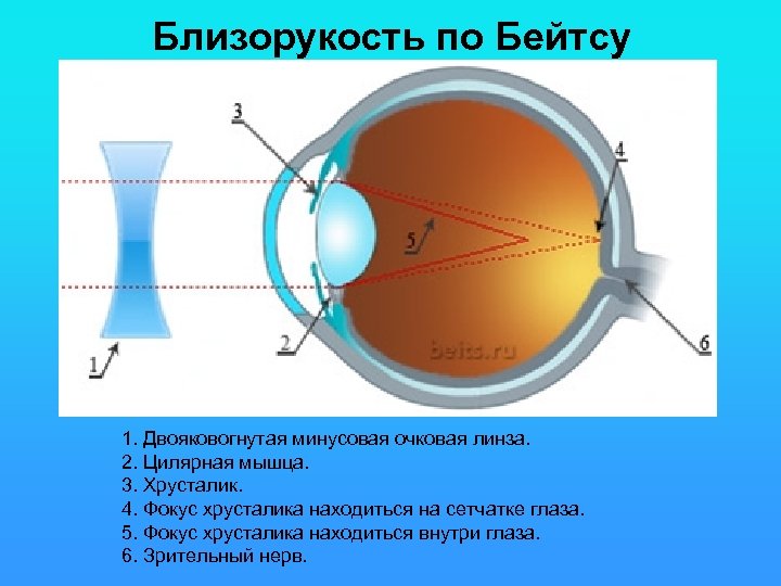 Близорукость по Бейтсу 1. Двояковогнутая минусовая очковая линза. 2. Цилярная мышца. 3. Хрусталик. 4.