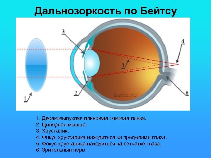 Дальнозоркость по Бейтсу 1. Двояковыпуклая плюсовая очковая линза. 2. Цилярная мышца. 3. Хрусталик. 4.