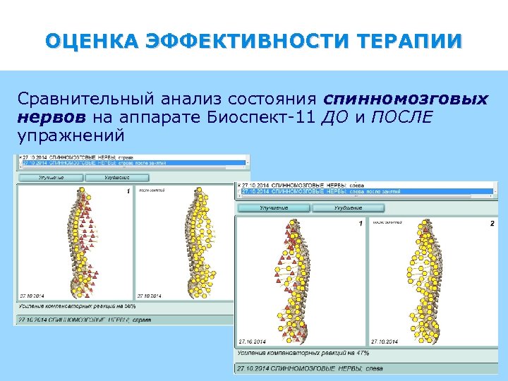 ОЦЕНКА ЭФФЕКТИВНОСТИ ТЕРАПИИ Сравнительный анализ состояния спинномозговых нервов на аппарате Биоспект-11 ДО и ПОСЛЕ