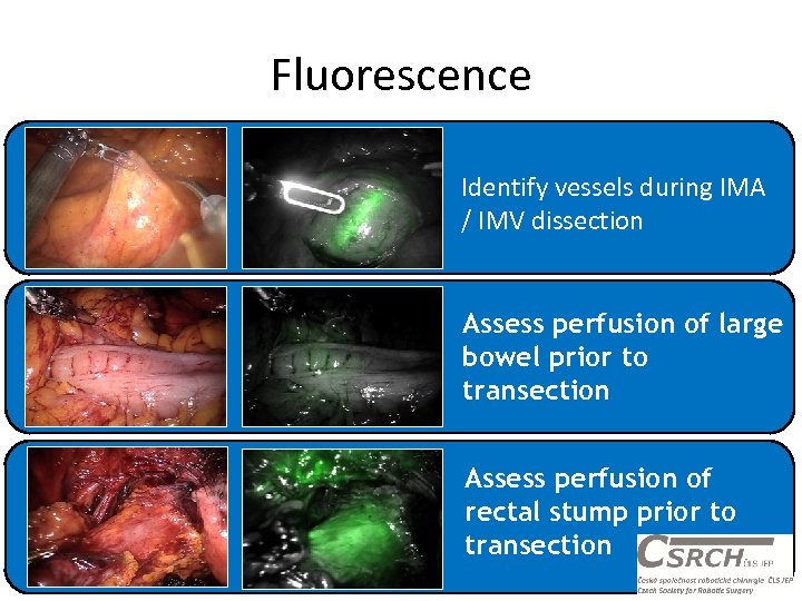 Fluorescence Identify vessels during IMA / IMV dissection Assess perfusion of large bowel prior