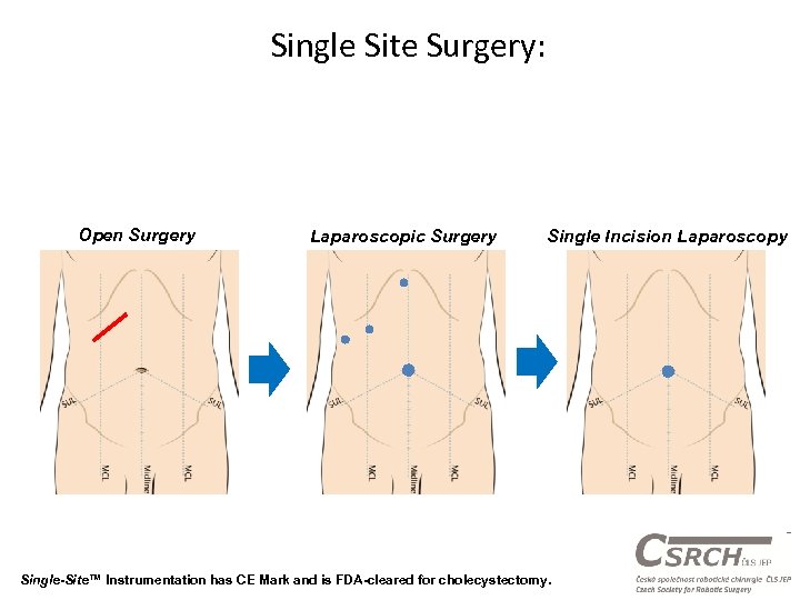 Single Site Surgery: Laparoscopic Surgery Single Incision Laparoscopy Single-Site™ Instrumentation has CE Mark and