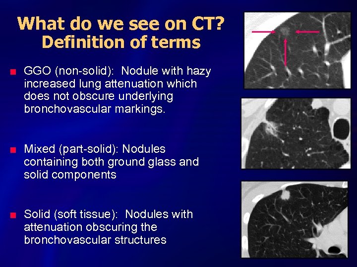 What do we see on CT? Definition of terms n n n GGO (non-solid):