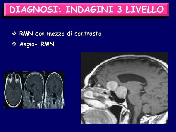 DIAGNOSI: INDAGINI 3 LIVELLO v RMN con mezzo di contrasto v Angio- RMN 