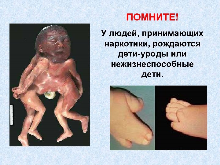 ПОМНИТЕ! У людей, принимающих наркотики, рождаются дети-уроды или нежизнеспособные дети. 