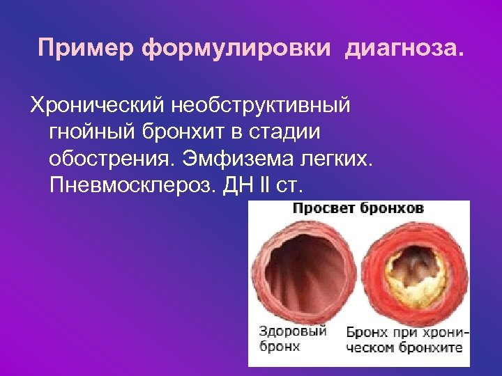 При необструктивном хроническом бронхите в клинической картине заболевания на первый план выступают