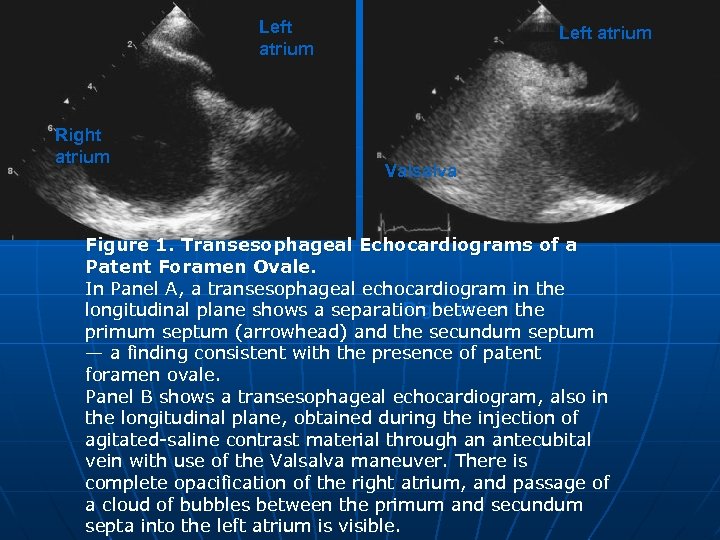 Left atrium Right atrium Left atrium Valsalva Figure 1. Transesophageal Echocardiograms of a Patent