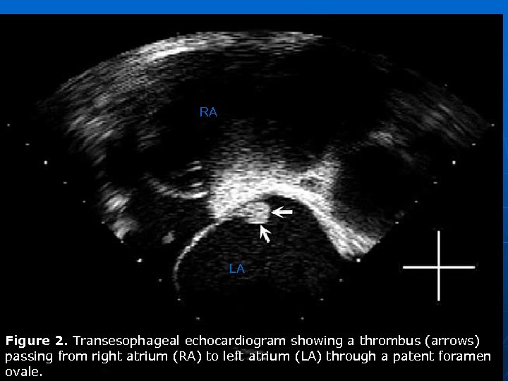 RA LA Figure 2. Transesophageal echocardiogram showing a thrombus (arrows) passing from right atrium