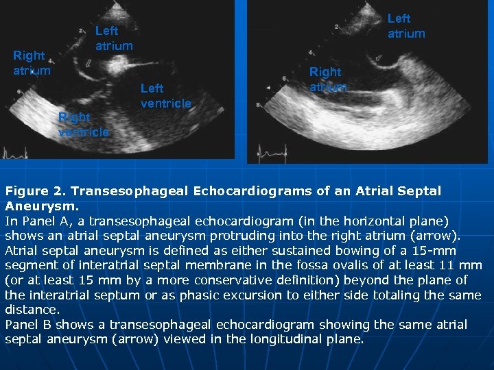 Right atrium Left ventricle Right atrium Right ventricle Figure 2. Transesophageal Echocardiograms of an