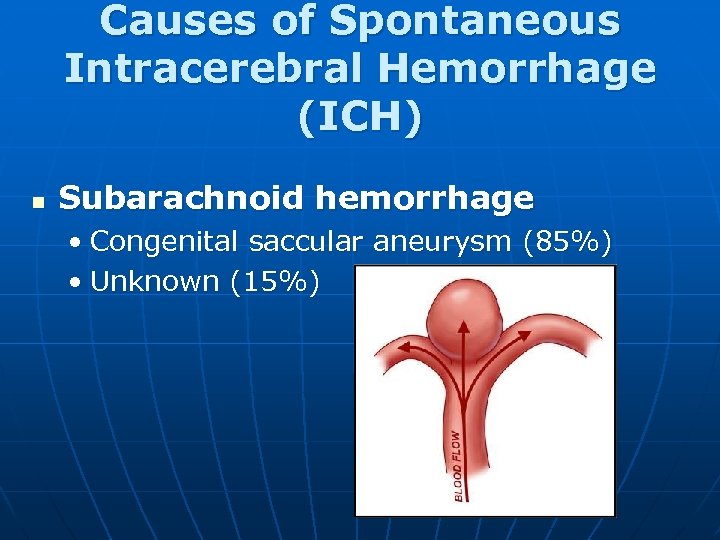 Causes of Spontaneous Intracerebral Hemorrhage (ICH) n Subarachnoid hemorrhage • Congenital saccular aneurysm (85%)
