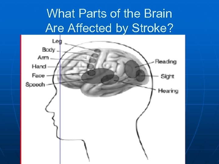 What Parts of the Brain Are Affected by Stroke? 