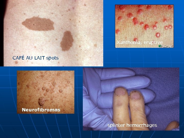 Xanthoma, eruptive CAFÉ AU LAIT spots Neurofibromas splinter hemorrhages 
