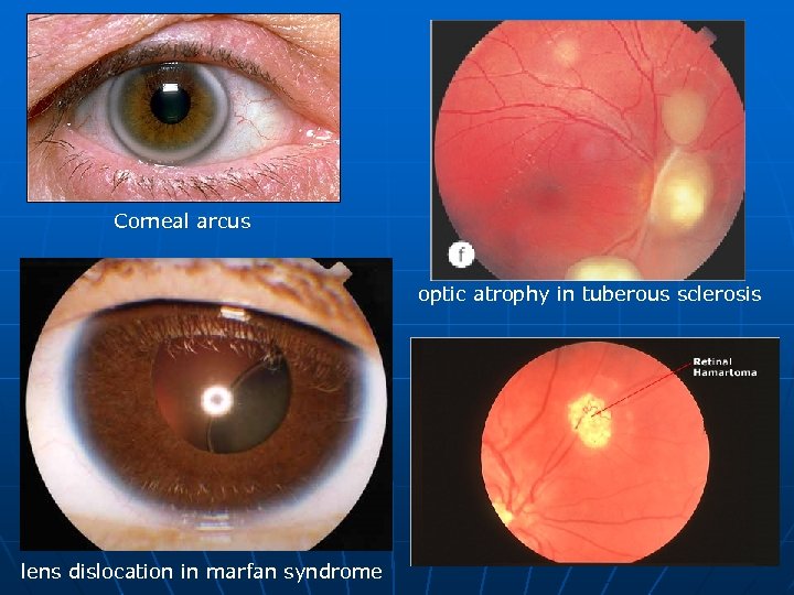Corneal arcus optic atrophy in tuberous sclerosis lens dislocation in marfan syndrome 