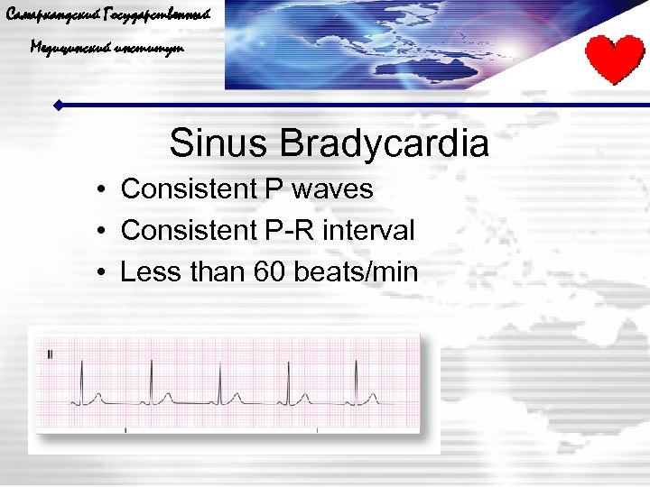 Самаркандский Государственный Медицинский институт Sinus Bradycardia • Consistent P waves • Consistent P-R interval