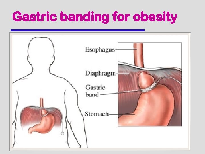 Gastric banding for obesity 