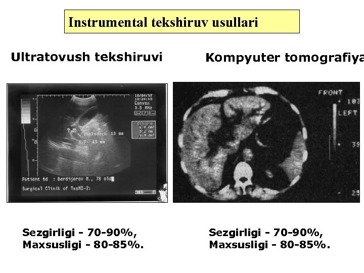 Instrumental tekshiruv usullari Ultratovush tekshiruvi Sezgirligi - 70 -90%, Maxsusligi - 80 -85%. Kompyuter