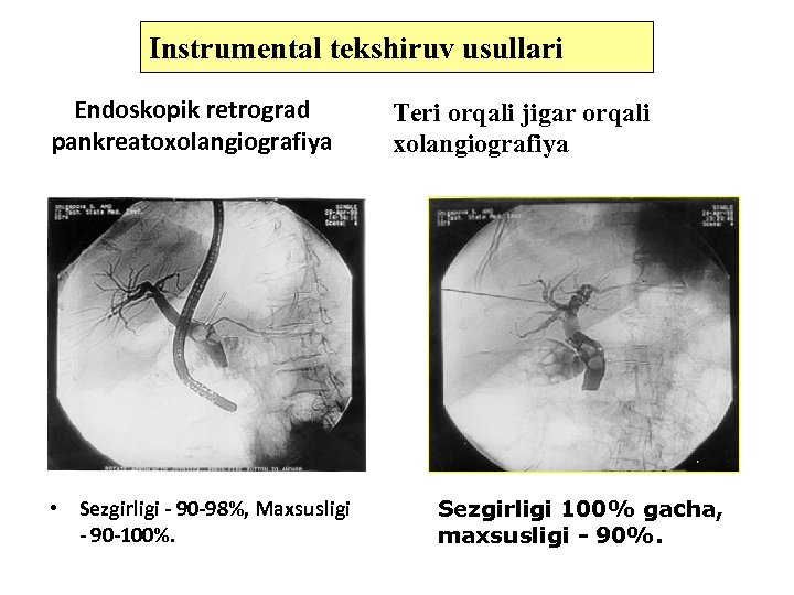 Instrumental tekshiruv usullari Endoskopik retrograd pankreatoxolangiografiya • Sezgirligi - 90 -98%, Maxsusligi - 90