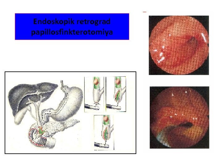 Endoskopik retrograd papillosfinkterotomiya 