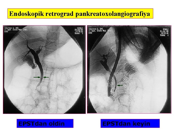 Endoskopik retrograd pankreatoxolangiografiya EPSTdan oldin EPSTdan keyin 