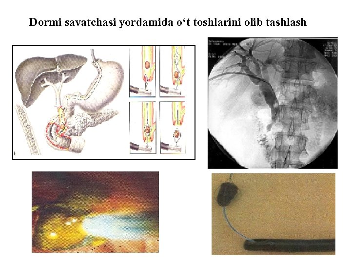 Dormi savatchasi yordamida o‘t toshlarini olib tashlash 