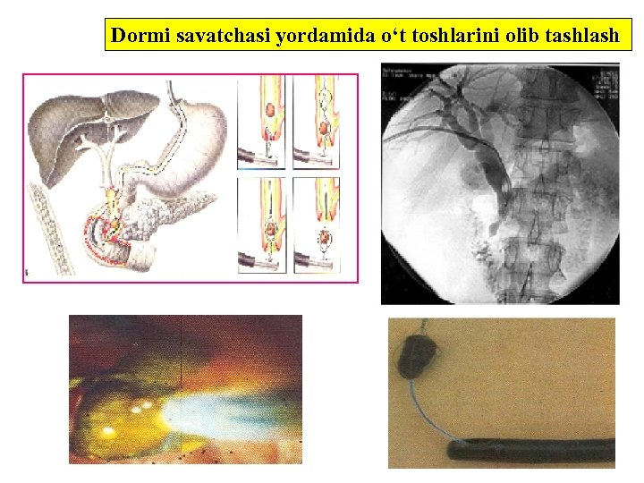 Dormi savatchasi yordamida o‘t toshlarini olib tashlash 