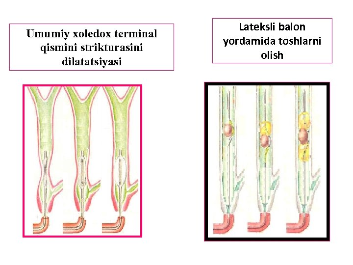 Umumiy xoledox terminal qismini strikturasini dilatatsiyasi Lateksli balon yordamida toshlarni olish 