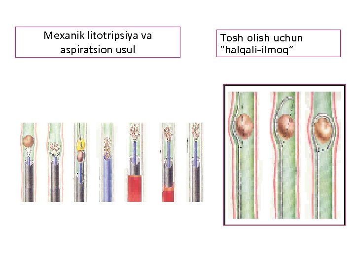 Mexanik litotripsiya va aspiratsion usul Tosh olish uchun “halqali-ilmoq” 