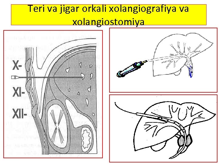 Teri va jigar orkali xolangiografiya va xolangiostomiya 