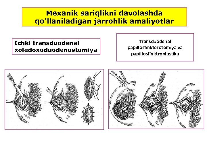 Mexanik sariqlikni davolashda qo‘llaniladigan jarrohlik amaliyotlar Ichki transduodenal xoledoxoduodenostomiya Transduodenal papillosfinkterotomiya va papillosfinktroplastika 