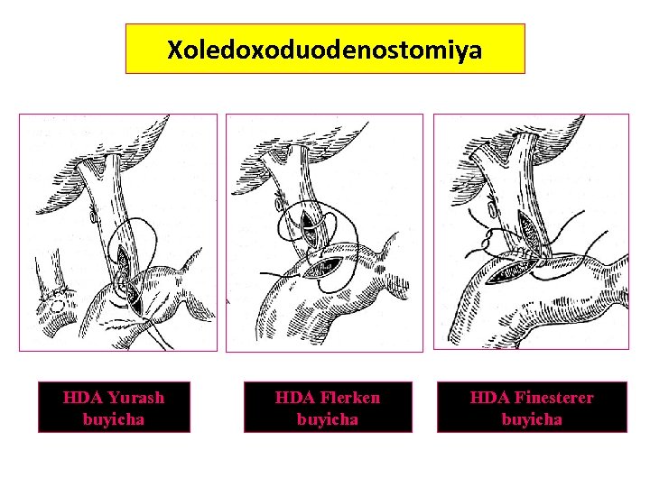 Xoledoxoduodenostomiya HDA Yurash buyicha HDA Flerken buyicha HDA Finesterer buyicha 