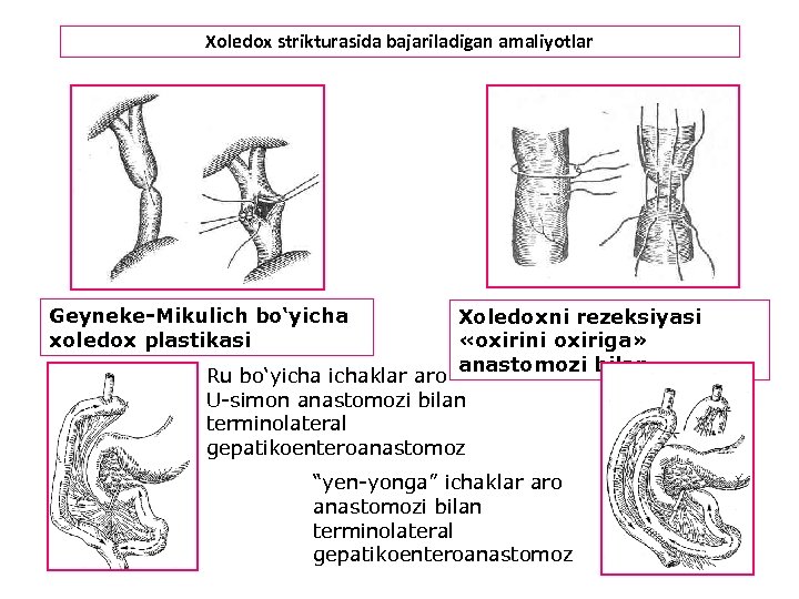 Xoledox strikturasida bajariladigan amaliyotlar Geyneke-Mikulich bo‘yicha xoledox plastikasi Xoledoxni rezeksiyasi «oxirini oxiriga» anastomozi bilan