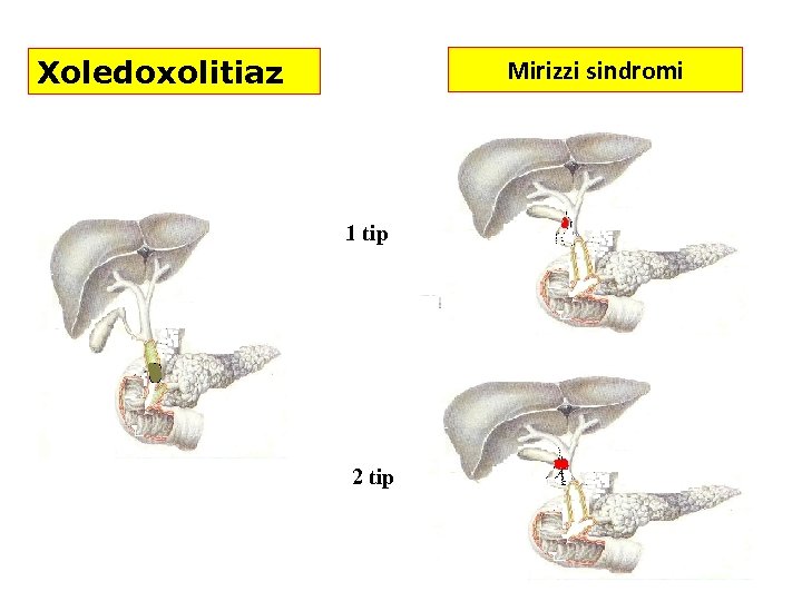 Xoledoxolitiaz Mirizzi sindromi 1 tip 2 tip 